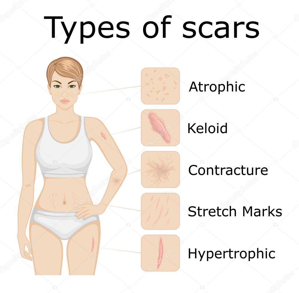 Illustration of five types of scars on the body of a young girl
