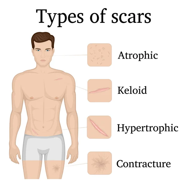 Ilustración Cuatro Tipos Cicatrices Cuerpo Hombre — Vector de stock