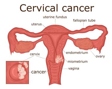 Illustration of the female reproductive system disease - cervical cancer clipart
