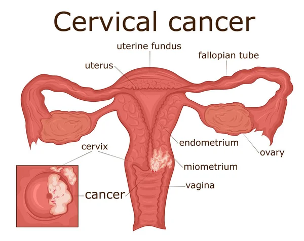 Ilustración Enfermedad Del Sistema Reproductor Femenino Cáncer Cuello Uterino — Vector de stock