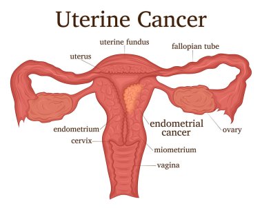 Illustration of the female reproductive system disease - uterine cancer clipart