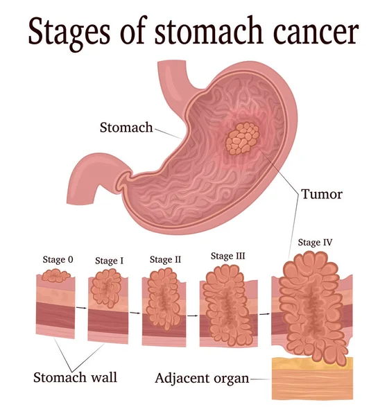 Entwicklungsstadien Eines Bösartigen Tumors Magenkrebs — Stockvektor