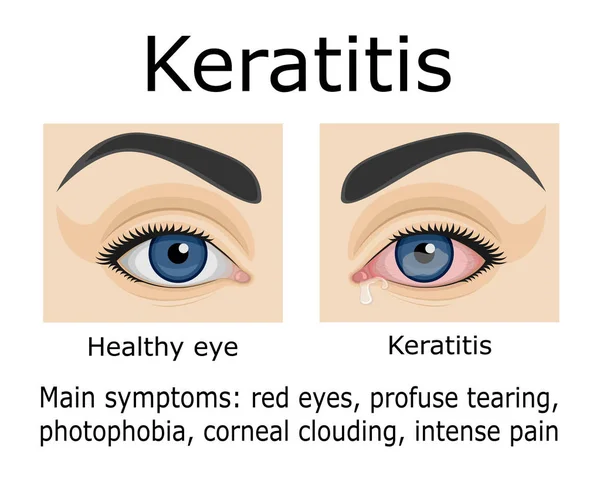 Tünetek Szemészeti Betegség Keratitis Illusztrációja — Stock Vector