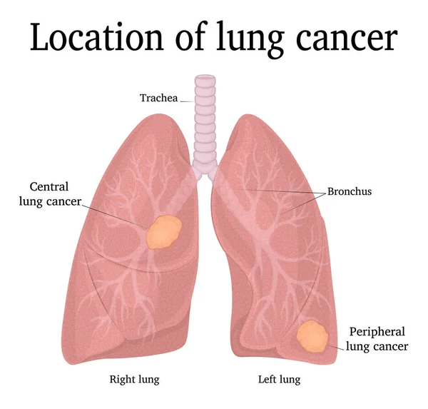 Emplacement Des Deux Types Cancer Poumon Cancer Central Cancer Périphérique — Image vectorielle