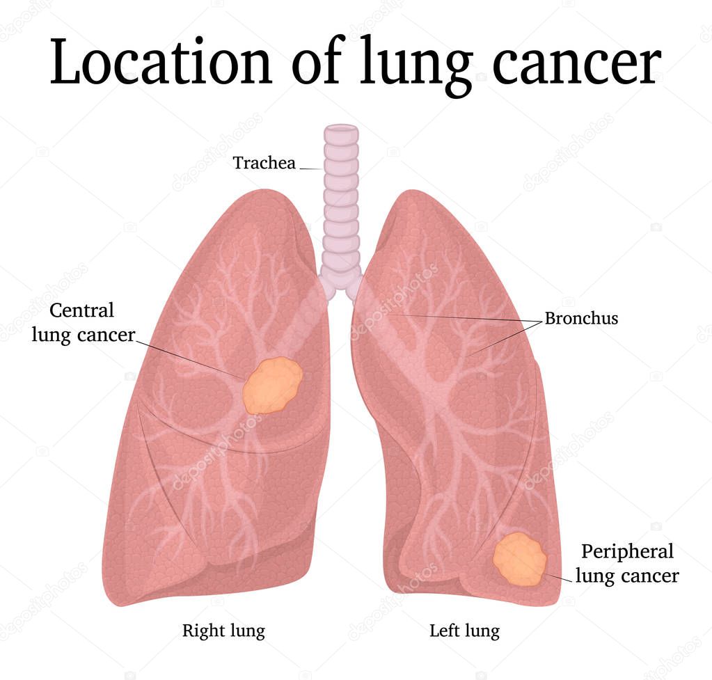 Location of the two types of lung cancer - the central and peripheral
