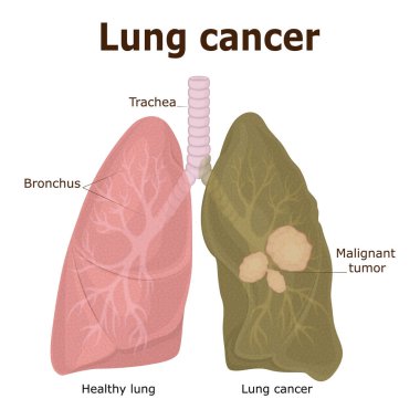 Malign bir tümör - akciğer kanseri çizimi