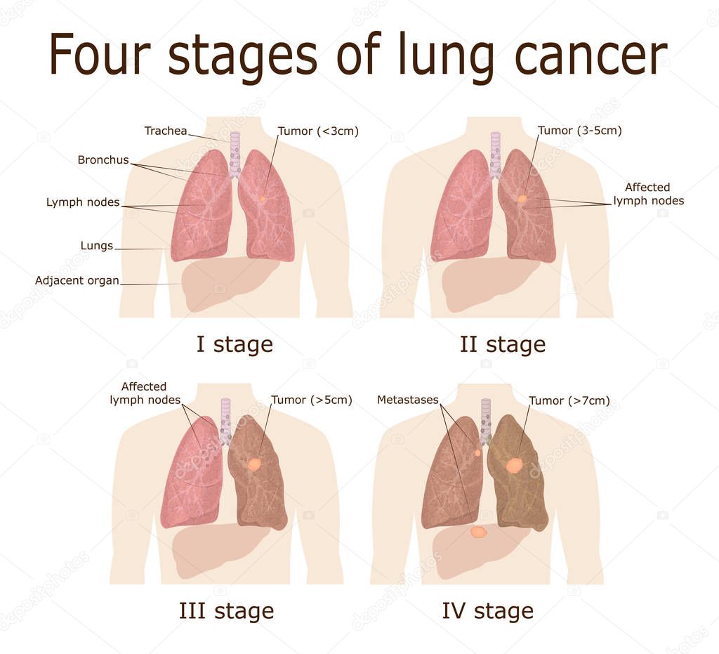 Illustration of the four stages of oncological disease - lung cancer
