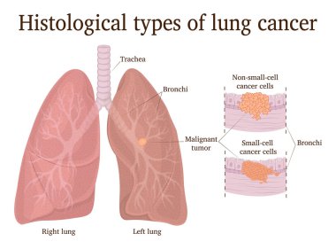 Histological types of lung cancer - small cell and non-small cell clipart