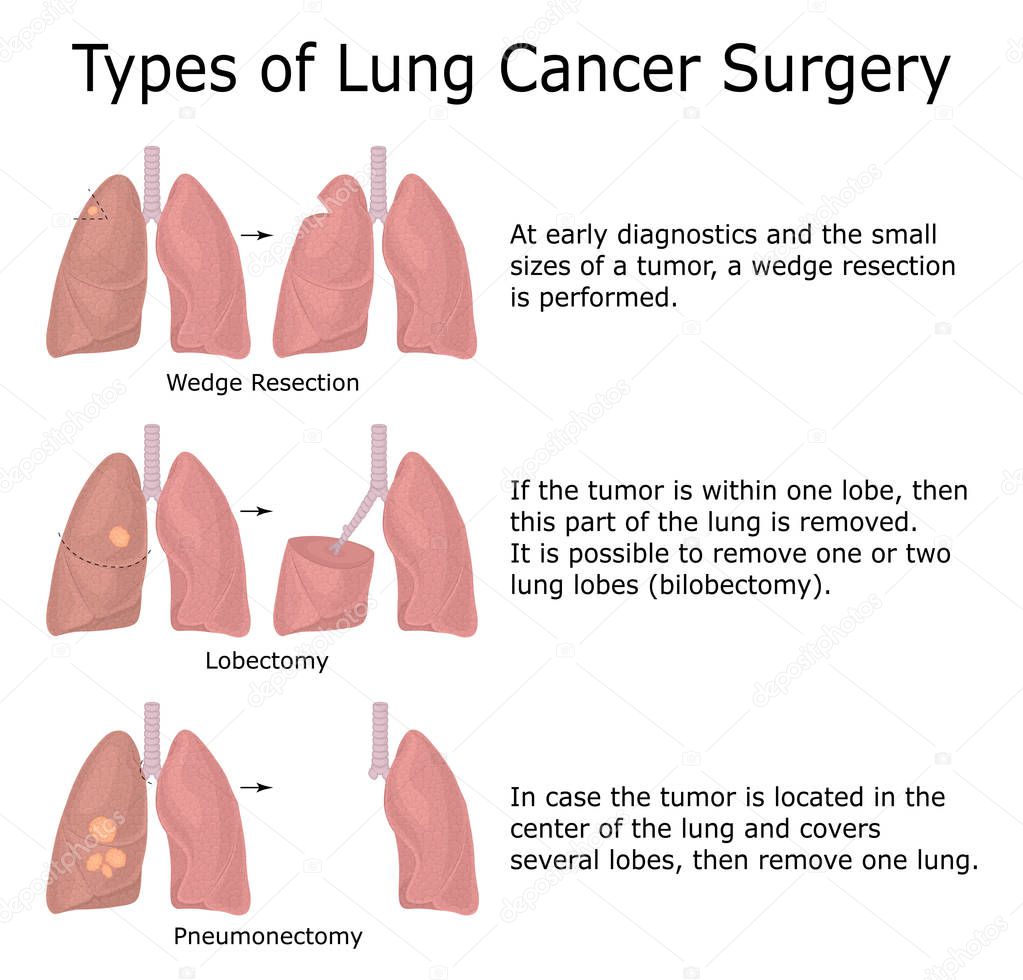 Illustration of three types of lung cancer surgery with descriptions