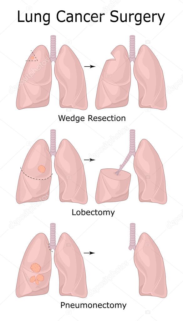 Illustration of different types of lung cancer surgery