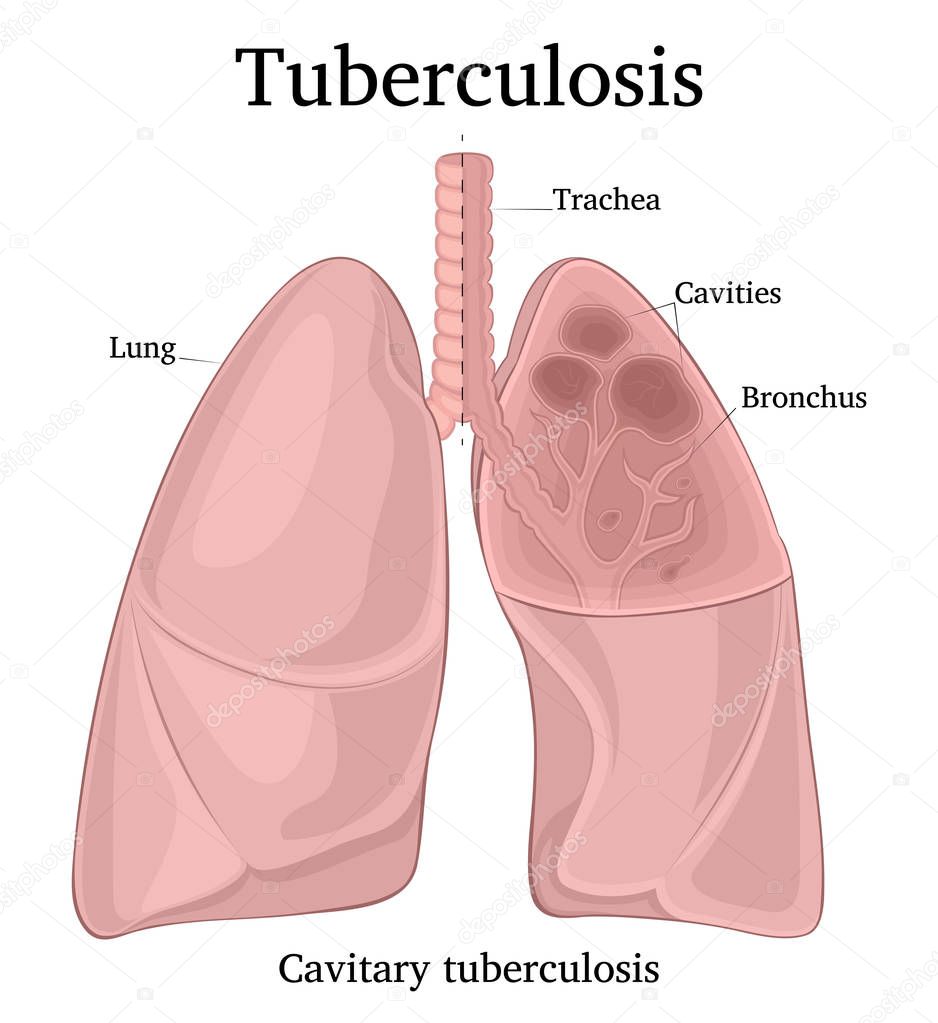 Illustration of the trachea and one lobe of the lung in section with symptoms of cavitary tuberculosis