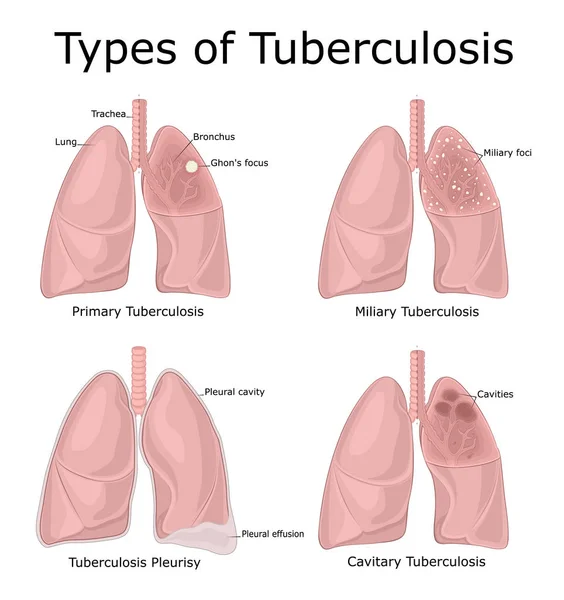 Ilustración Diferentes Tipos Tuberculosis Primaria Miliar Cavitaria Pleuresía — Vector de stock