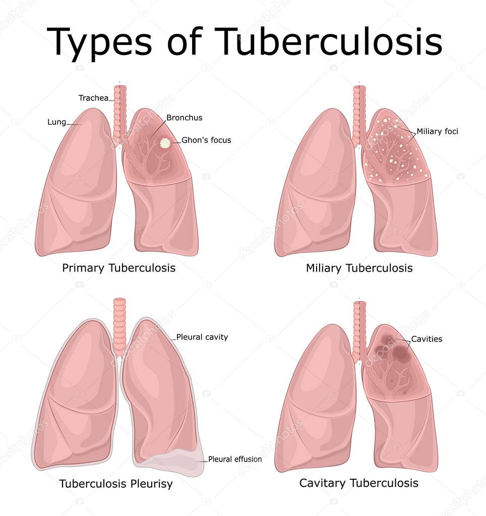 Illustration of different types of tuberculosis - primary, miliary, cavitary, pleurisy