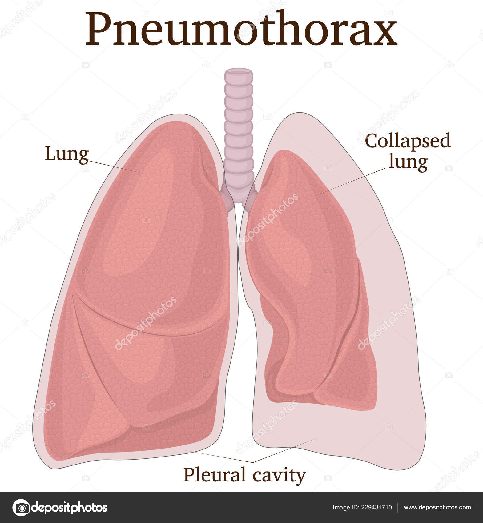Illustration Lungs Symptoms Pneumothorax Stock Vector Image by  © #229431710