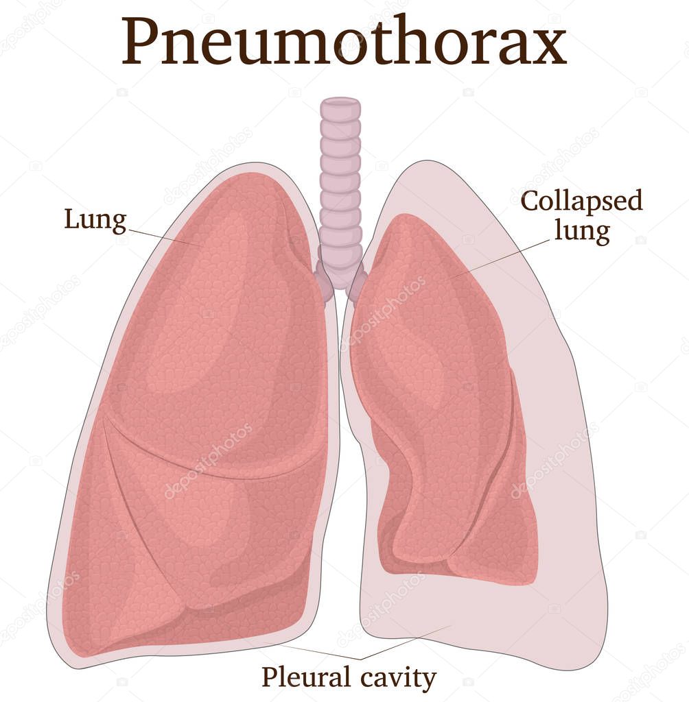 Illustration of the lungs with symptoms of pneumothorax