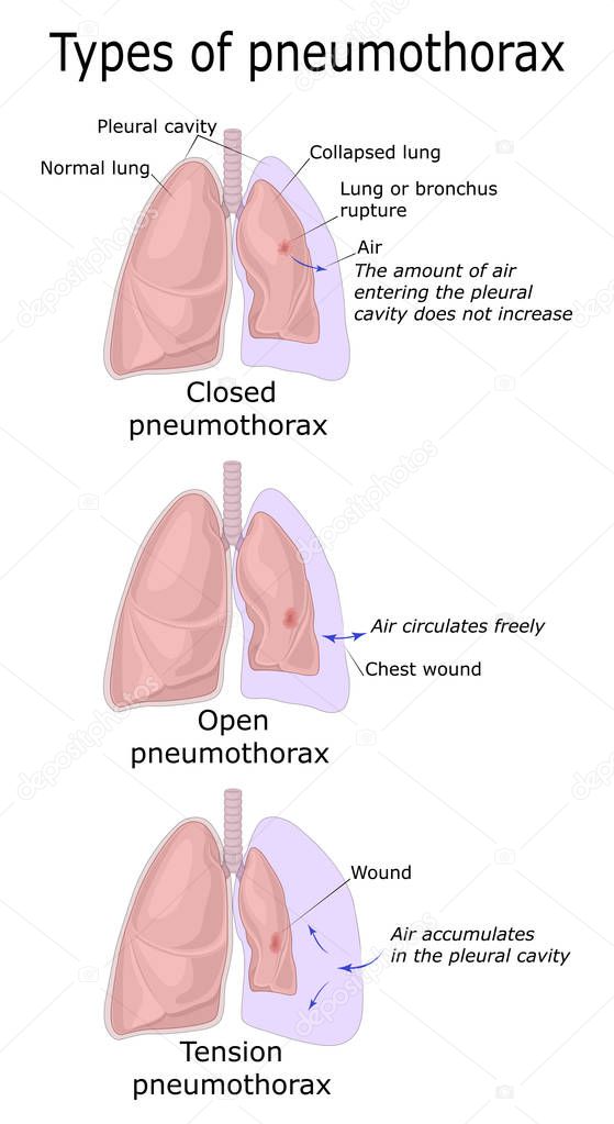 Illustration of three types of Pneumothorax - Closed, Open and Tension