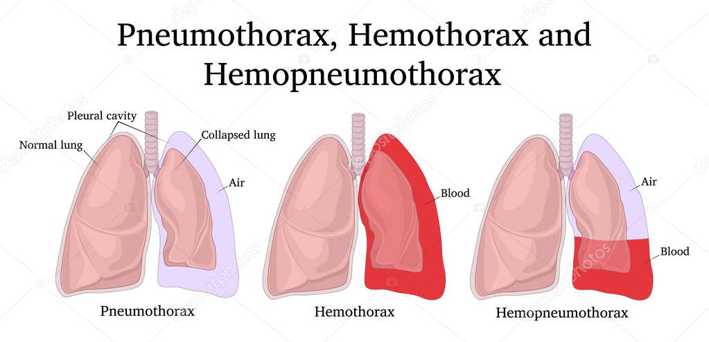 Illustration of complications after a chest injury - Pneumothorax, Hemothorax and Hemopneumothorax