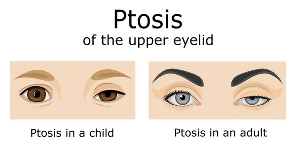 Ilustración Los Ojos Niño Adulto Con Síntomas Ptosis Del Párpado — Vector de stock