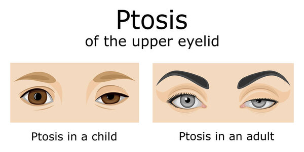 Illustration of the eyes of a child and an adult with symptoms of Ptosis of the upper eyelid