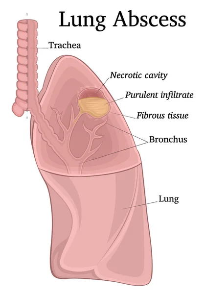 Illustration Poumon Sectionné Représentant Une Cavité Purulente Nécrotique Abcès — Image vectorielle