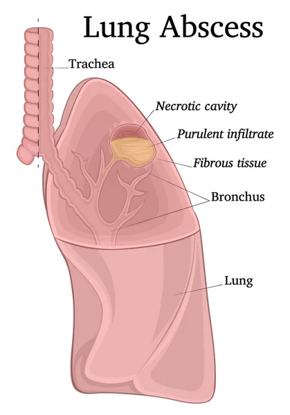 断面化された肺膿瘍 化膿性壊死キャビティを描いたのイラスト — ストックベクタ