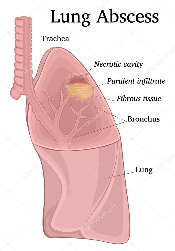 Illustration of a sectioned lungs depicting a purulent-necrotic cavity - an abscess