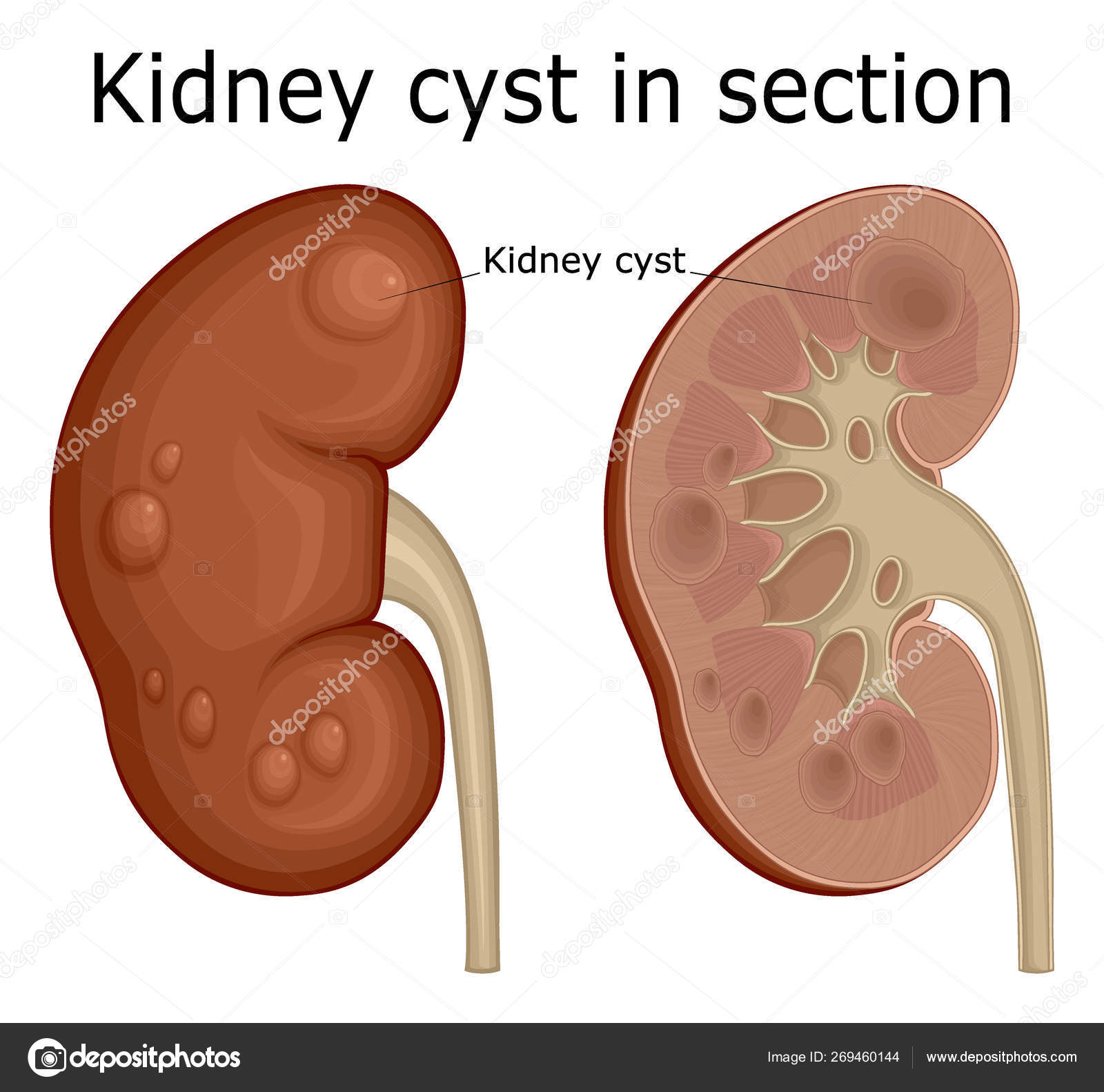 простая солитарная киста почки. кисты почек bosniak. парапельвикальные кисты почек что это такое. киста почки с геморрагическим содержимым мрт. киста почки в средней трети.