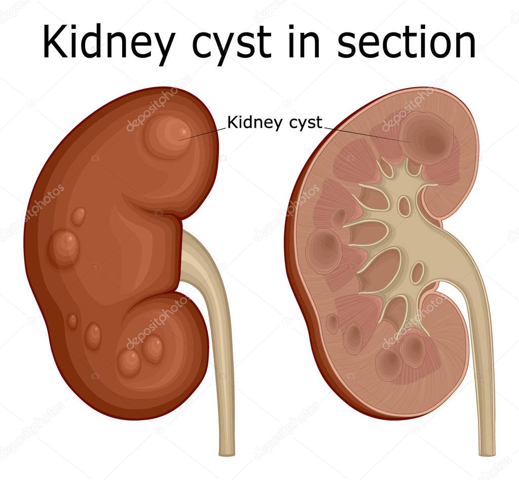 Illustration of a urological disease of a kidney cyst in a section