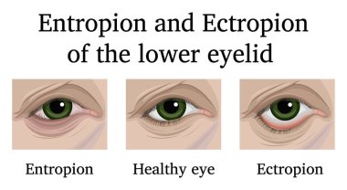 Illustration of ophthalmic diseases Entropion and Ectropion of the lower eyelid clipart