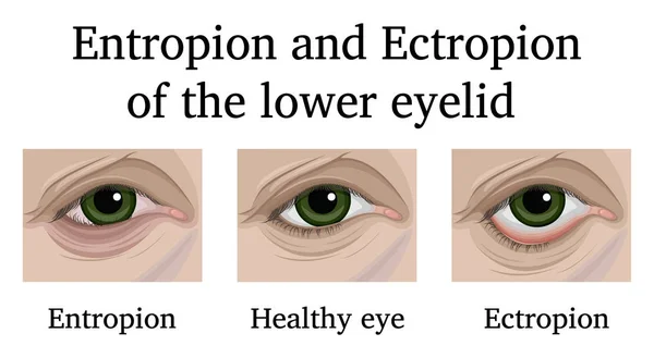 Illustration Ophthalmic Diseases Entropion Ectropion Lower Eyelid — Stock Vector