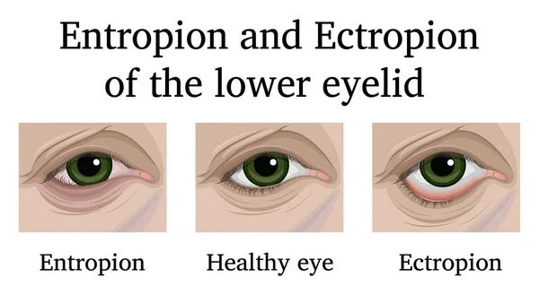 Illusztráció Szemészeti Betegségek Entropion Ectropion Alsó Szemhéj — Stock Vector