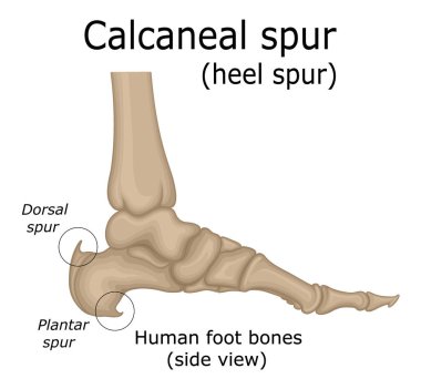 Illustration of the heel spur, which is a calcium deposit that promotes the appearance of a bone protrusion on the heel clipart