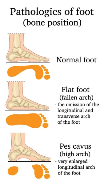 Иллюстрация Расположения Костей Патологиях Стопы — стоковый вектор