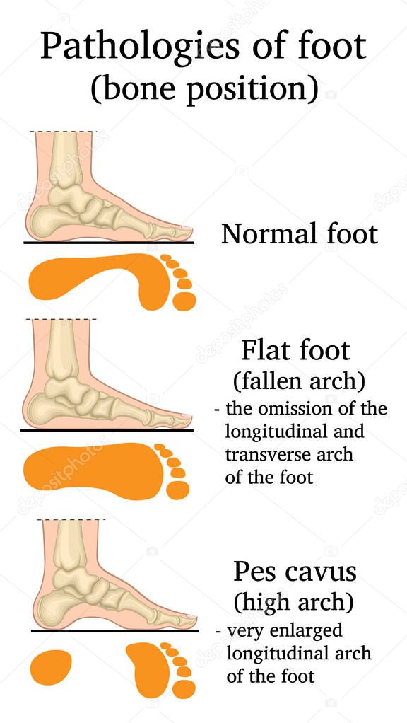 Illustration of the location of bones in pathologies of the foot