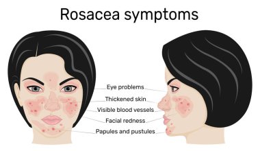 Rosacea semptomlarının tam bir yüz ve profil üzerinde yansıması.