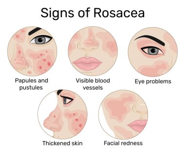 Cilt kızarıklığı, papüller ve kabarcıklar, görülebilir kan damarları, cilt kalınlaşması ve göz sorunları gibi beş Rosacea işaretinin bir göstergesi.