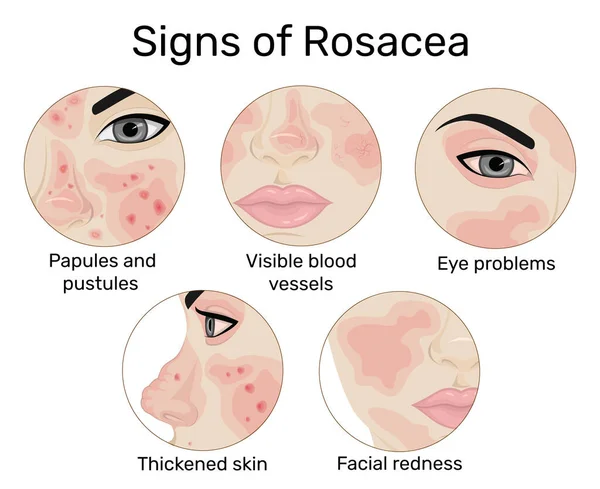 Cilt kızarıklığı, papüller ve kabarcıklar, görülebilir kan damarları, cilt kalınlaşması ve göz sorunları gibi beş Rosacea işaretinin bir göstergesi.