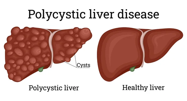 说明健康的肝脏及多囊性肝脏 — 图库矢量图片