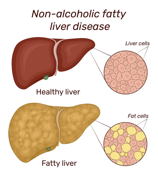 Ilustración Enfermedad Del Hígado Graso Alcohólico Para Comparación Muestra Hígado — Vector de stock