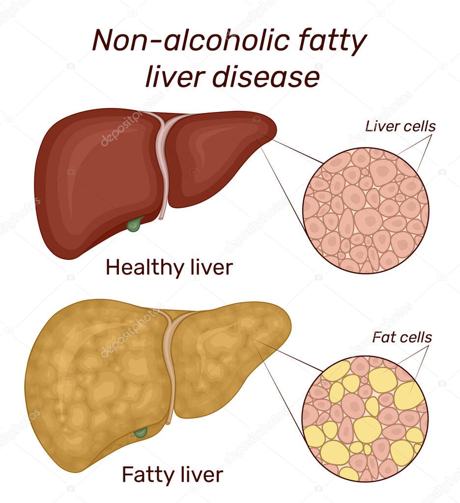 Illustration of non-alcoholic fatty liver disease. For comparison shows the healthy and diseased liver