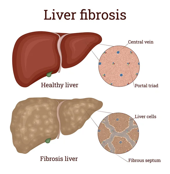Illusztráció Májbetegség Fibrosis Amely Túlnő Hegszövet — Stock Vector