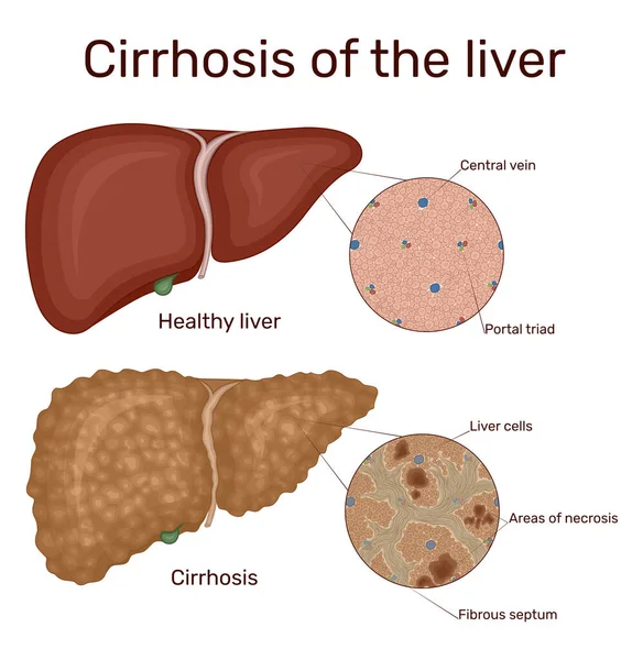 Kronik karaciğer hastalığının sirozu. İfade etmek sağlıklı ve hastalıklı bir karaciğerdir.