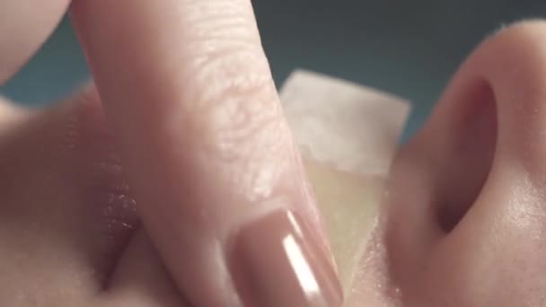 Uiterst close-up, vrouwelijke gezicht haar verwijdering wax strips — Stockvideo