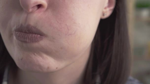 Close-up rosacea op de dames gezicht — Stockvideo