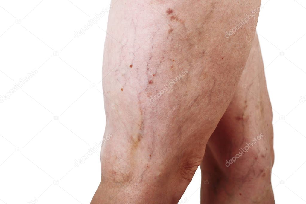the disease varicose veins on a legs