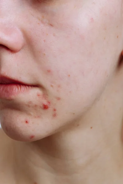 Mulheres jovens com pele problemática e espinhas no rosto. Feamle mostrando a acne dela. Skincare, beleza e conceito de spa — Fotografia de Stock