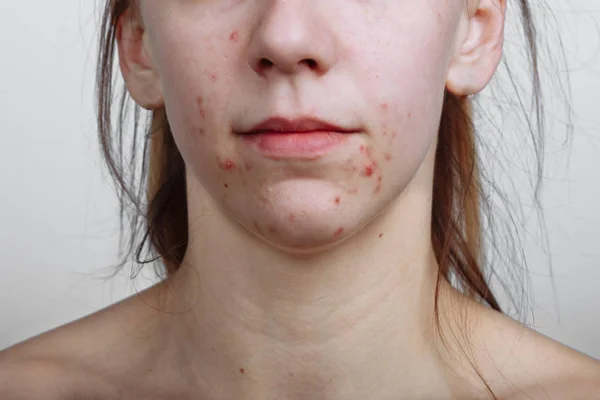 Mulheres jovens com pele problemática e espinhas no rosto. Feamle mostrando a acne dela. Skincare, beleza e conceito de spa — Fotografia de Stock