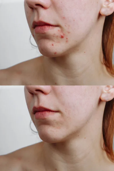 Mulher jovem antes e depois do tratamento da acne, close-up. Conceito de cuidados da pele — Fotografia de Stock