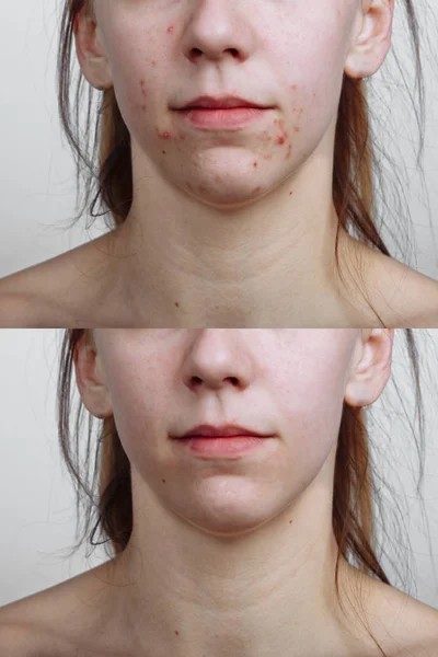 Mulher jovem antes e depois do tratamento da acne, close-up. Conceito de cuidados da pele — Fotografia de Stock