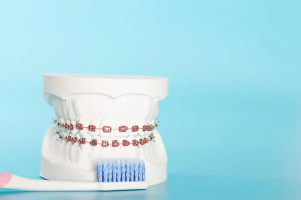 Orthodontic dental model in oral health concept.